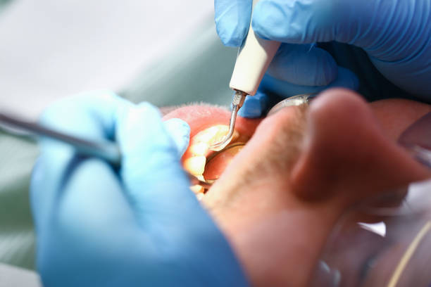 Best Emergency Wisdom Teeth Removal in Shell Valley, ND